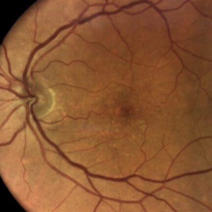 Extrafoveal hypopigmented multifocal lesions. Image courtesy of Dr. Julie Rodman.