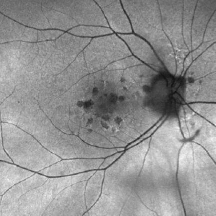 Multifocal extrafoveal lesions with branches of hyperfluorescence. Image courtesy of Dr. Mohammad Rafieetary.