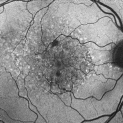 Multifocal lesions with diffuse pattern of hypo- and hyperfluorescence. Image courtesy of Dr. Mary Beth Yackey.