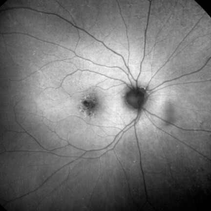 Small, dark hypofluorescent lesions with surrounding areas of hyperfluorescence. Image courtesy of Dr. Mark Dunbar.