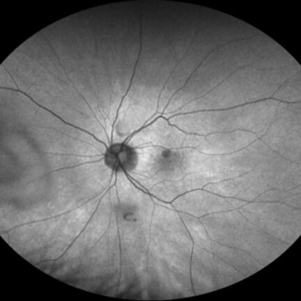 Early extrafoveal unifocal hypofluorescent lesion. Image courtesy of Dr. Julie Rodman.