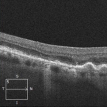 Small extrafoveal GA lesion. Image courtesy of Dr. Mark Dunbar.