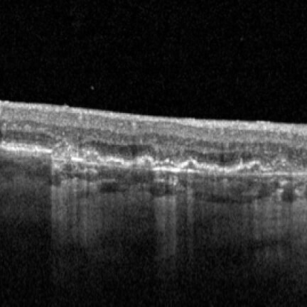 Hypertransmission defects with layer loss and hyperreflective foci. Image courtesy of Dr. Mohammad Rafieetary.