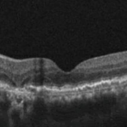 Choroidal hypertransmission with hyporeflective wedges flanking the area of RPE, PR, and choriocapillaris layer loss. Image courtesy of Dr. Julie Rodman.