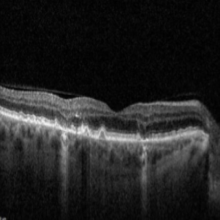 Multifocal GA. Image courtesy of Dr. Roya Attar.