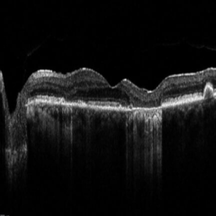 Non–center point involved GA. Image courtesy of Dr. Roya Attar.