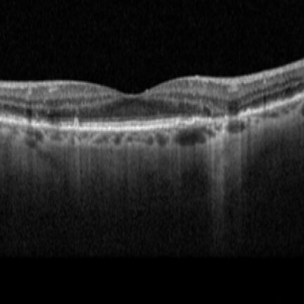 Transmission defect from early GA. Image courtesy of Dr. Jessica Haynes.