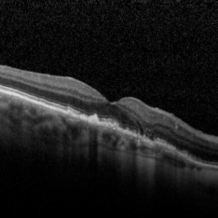 Early unilateral, extrafoveal GA with reticular pseudodrusen subfoveal and hyporeflective wedges flanking area of transmission defect. Image courtesy of Dr. Mary Beth Yackey.